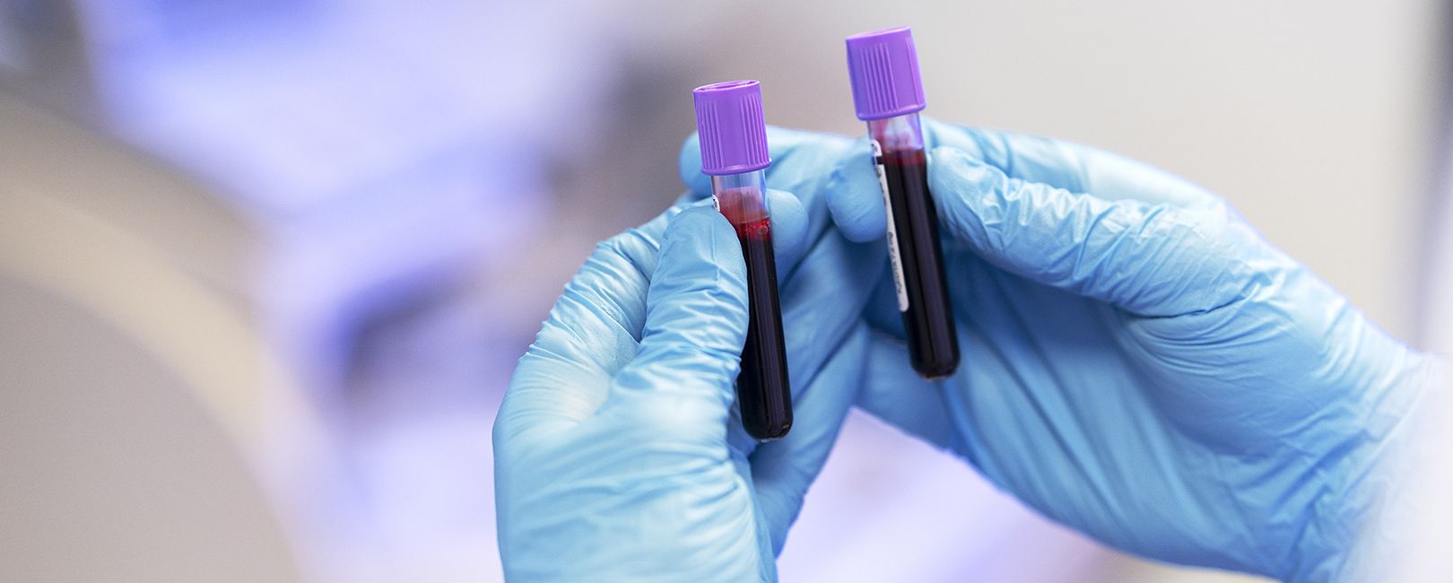 Diagnóstico de trombofilia: ANS inclui exame no rol dos planos de saúde