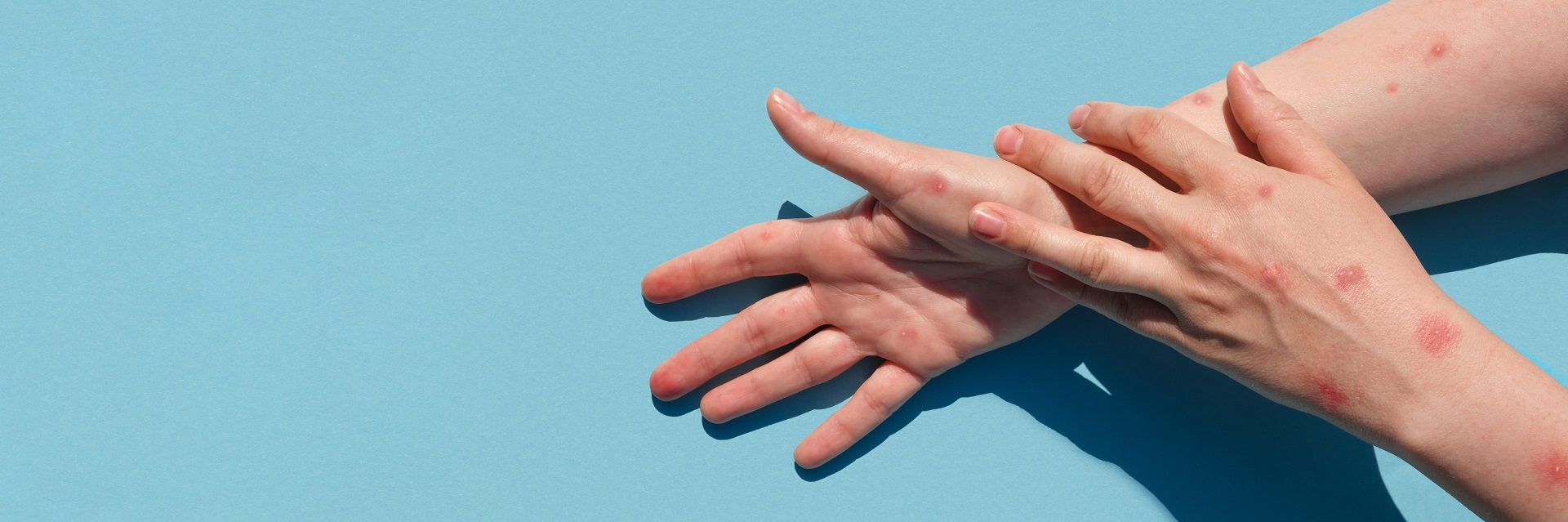 O que é Varíola dos Macacos: sintomas, transmissão e prevenção